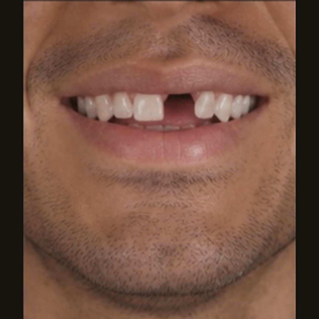 Before treatment